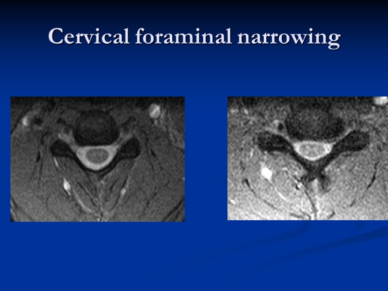 Cervical foraminal narrowing